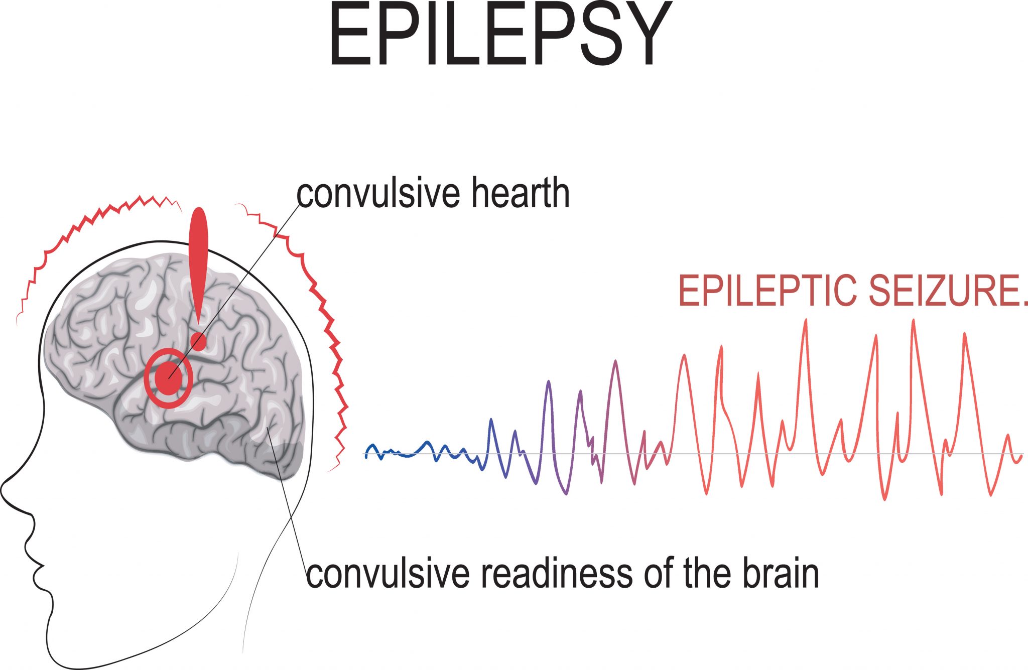 Epilepsy monitoring - Medrecord