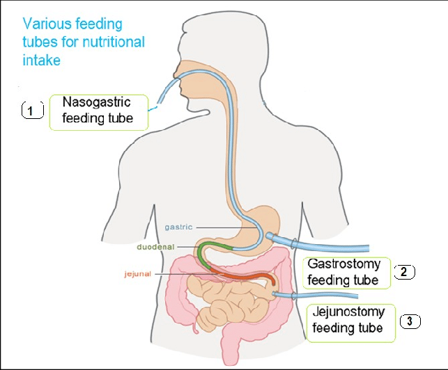 Gj Tube With Tube Feeds Diagram